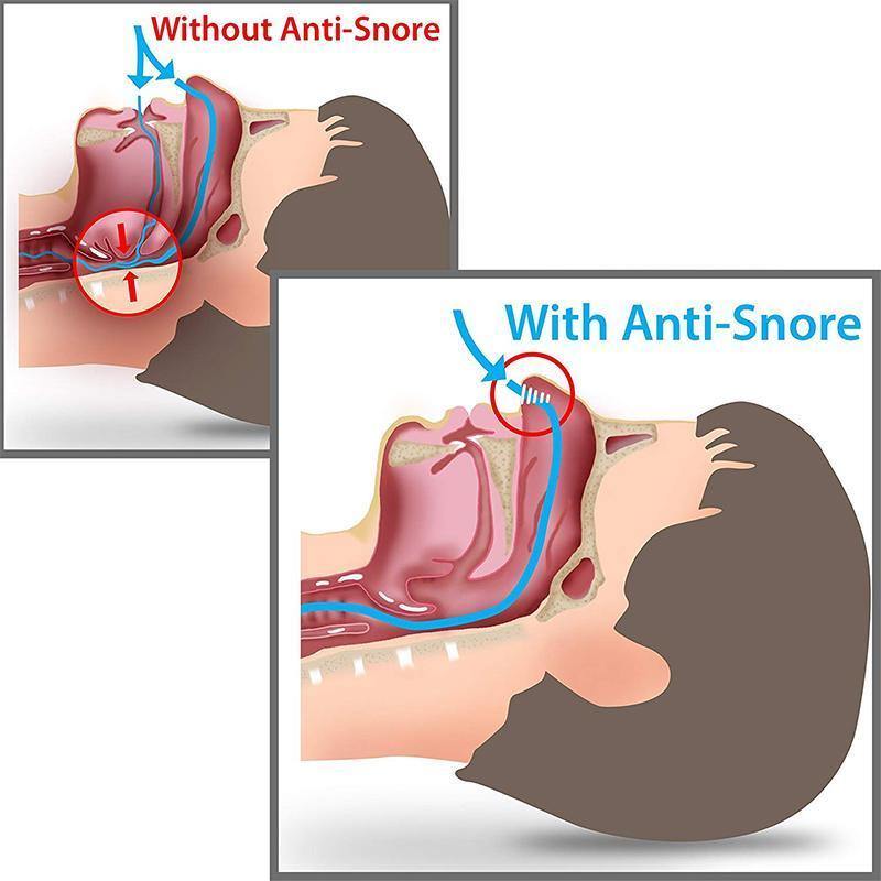 Anti Snore Device (SNORE RELIEF) - Clauve